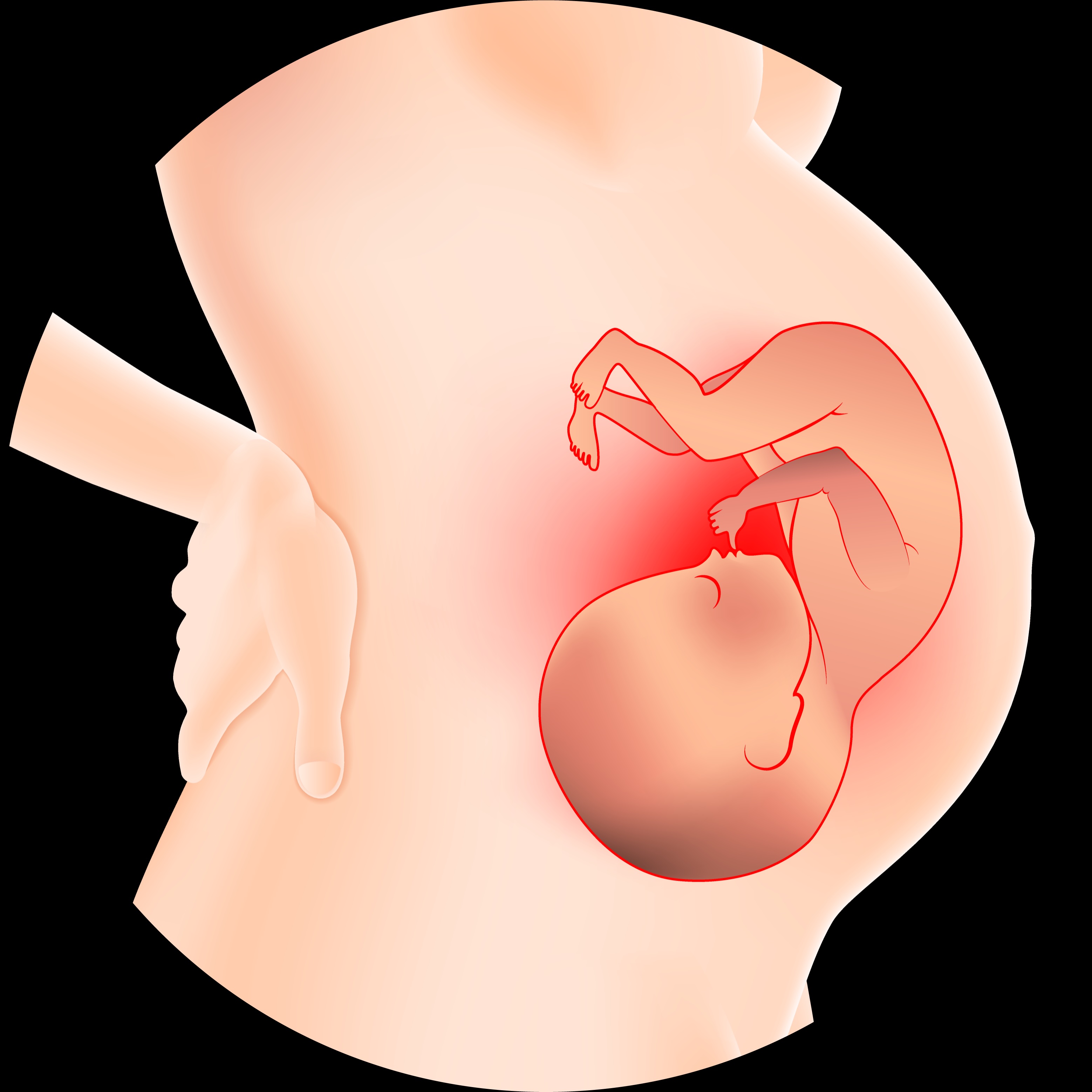 Syphilis During Pregnancy and Congenital Syphilis Icon